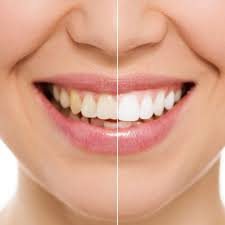 Teeth Whitening